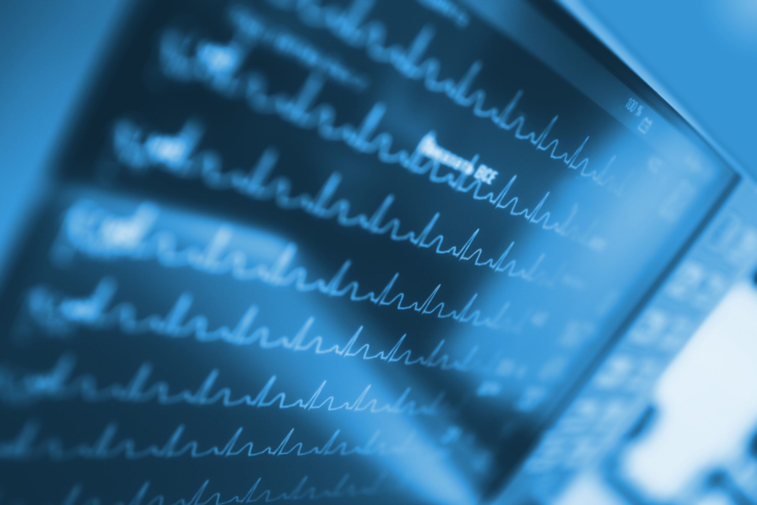 Close-up of blue heart monitor screens displaying multiple EKG waveform readings.